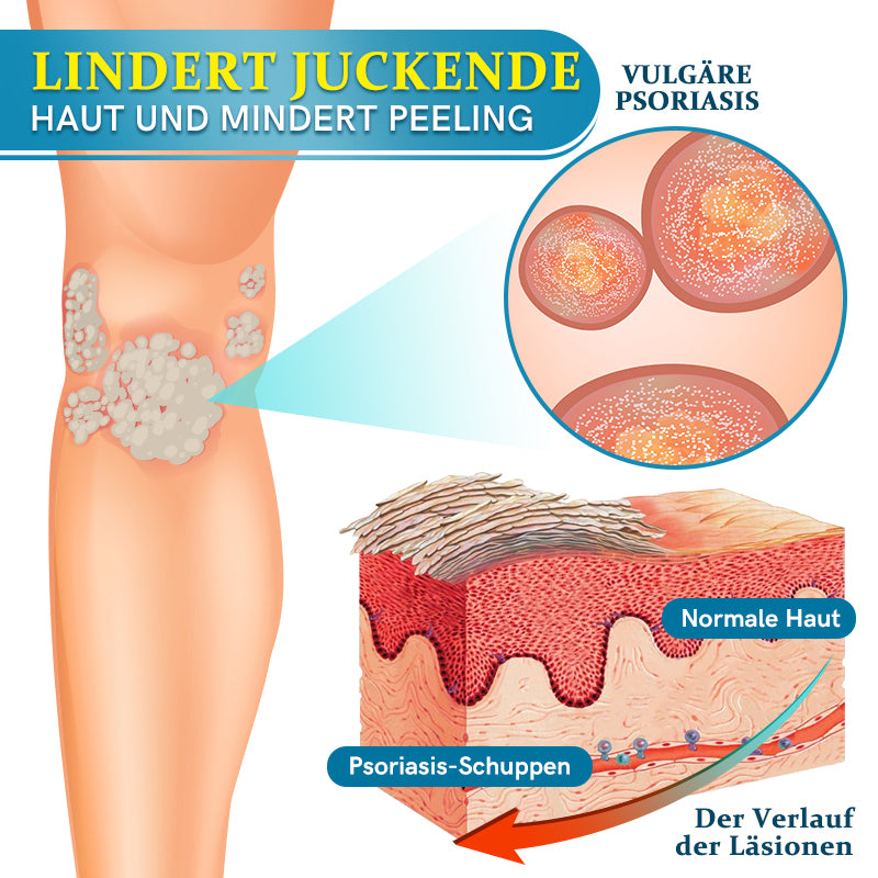 Ourlyard™  Multi-Symptom Psoriasis-Behandlungscreme（👨‍⚕Vom Arzt empfohlen）