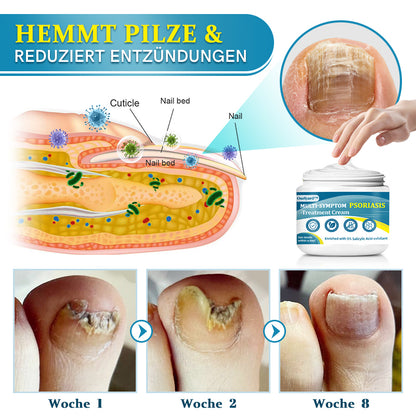 Ourlyard™  Multi-Symptom Psoriasis-Behandlungscreme（👨‍⚕Vom Arzt empfohlen）