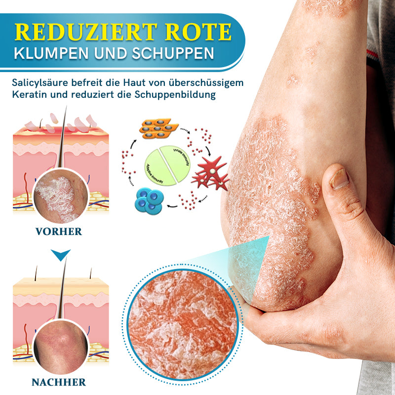 Ourlyard™  Multi-Symptom Psoriasis-Behandlungscreme（👨‍⚕Vom Arzt empfohlen）